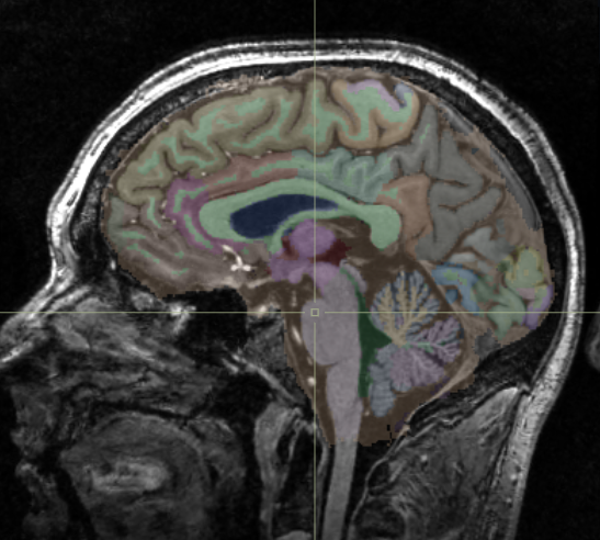 Sagittal MRI with coloured anatomical segmentation